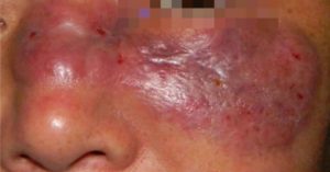 ¿Cómo se desarrolla y cuál es el riesgo de la infección del hongo negro?: Epidemiólogo Rafael Orihuela lo explica