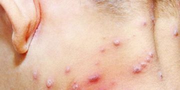 Venezuela y viruela del mono