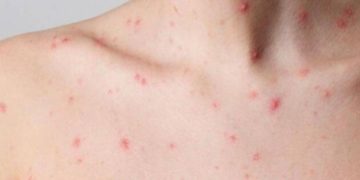 Viruela del mono y Nueva York