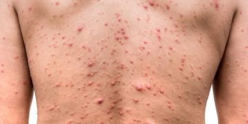 Viruela del mono y Estados Unidos